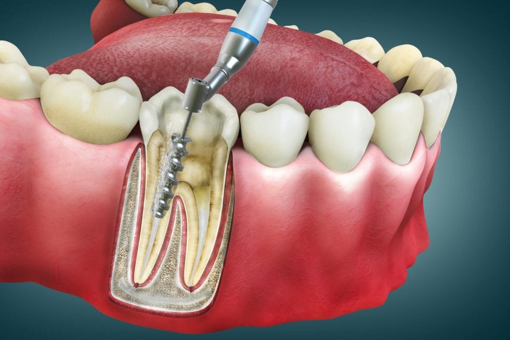 Root-Canal-1024x683