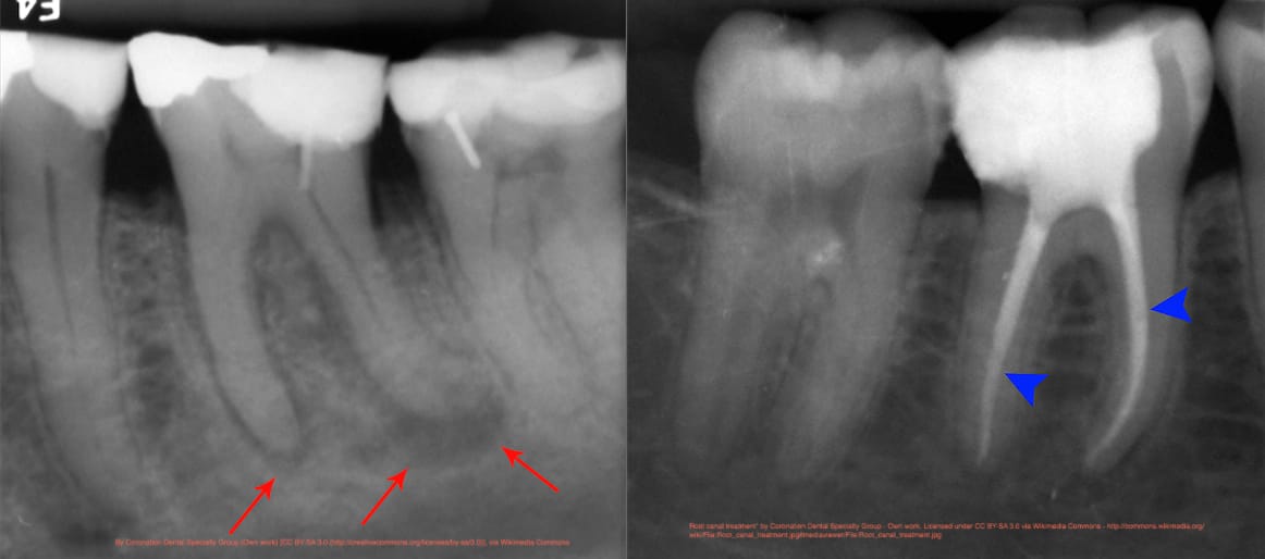 Root+canal+radiograp+x-rays+showing+molar+teeth+before+and+after+treatment