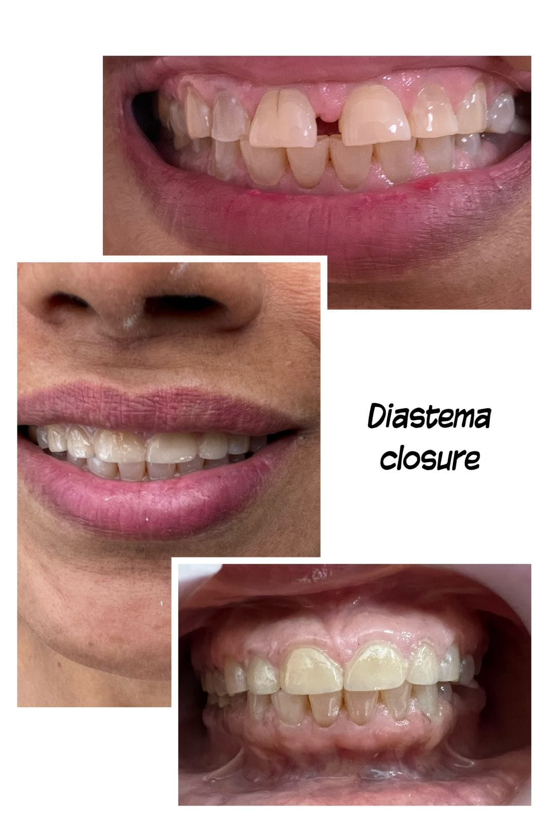smile design gap closure