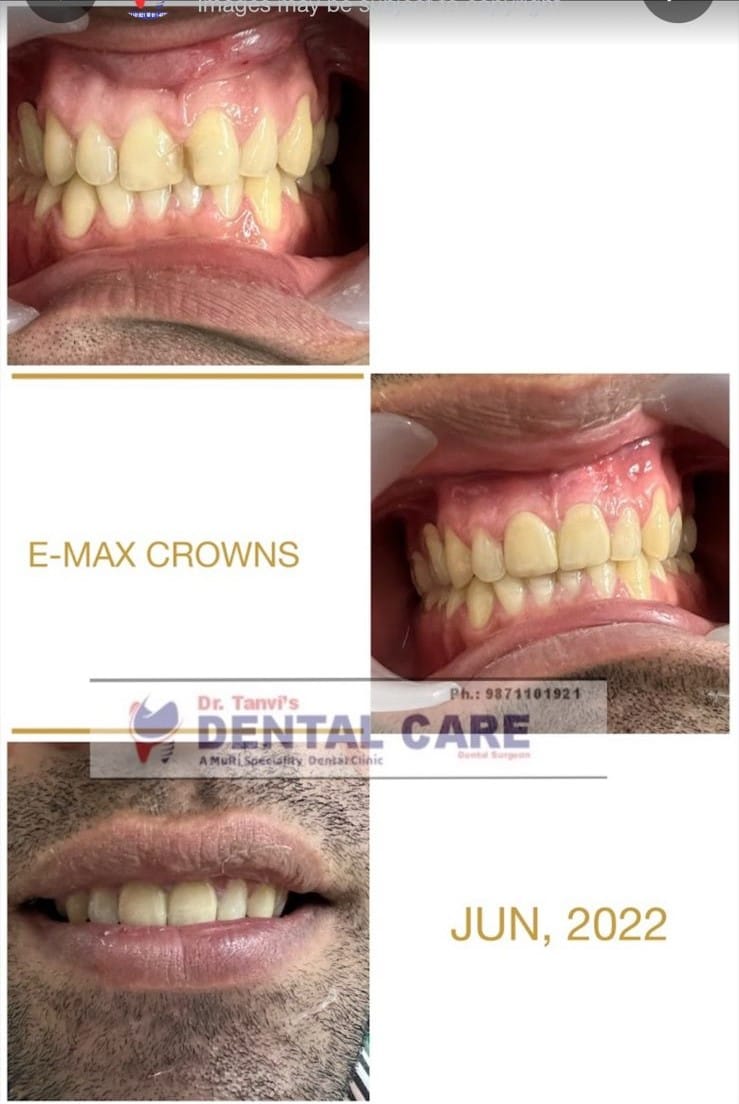 smile designing (metal free crown)