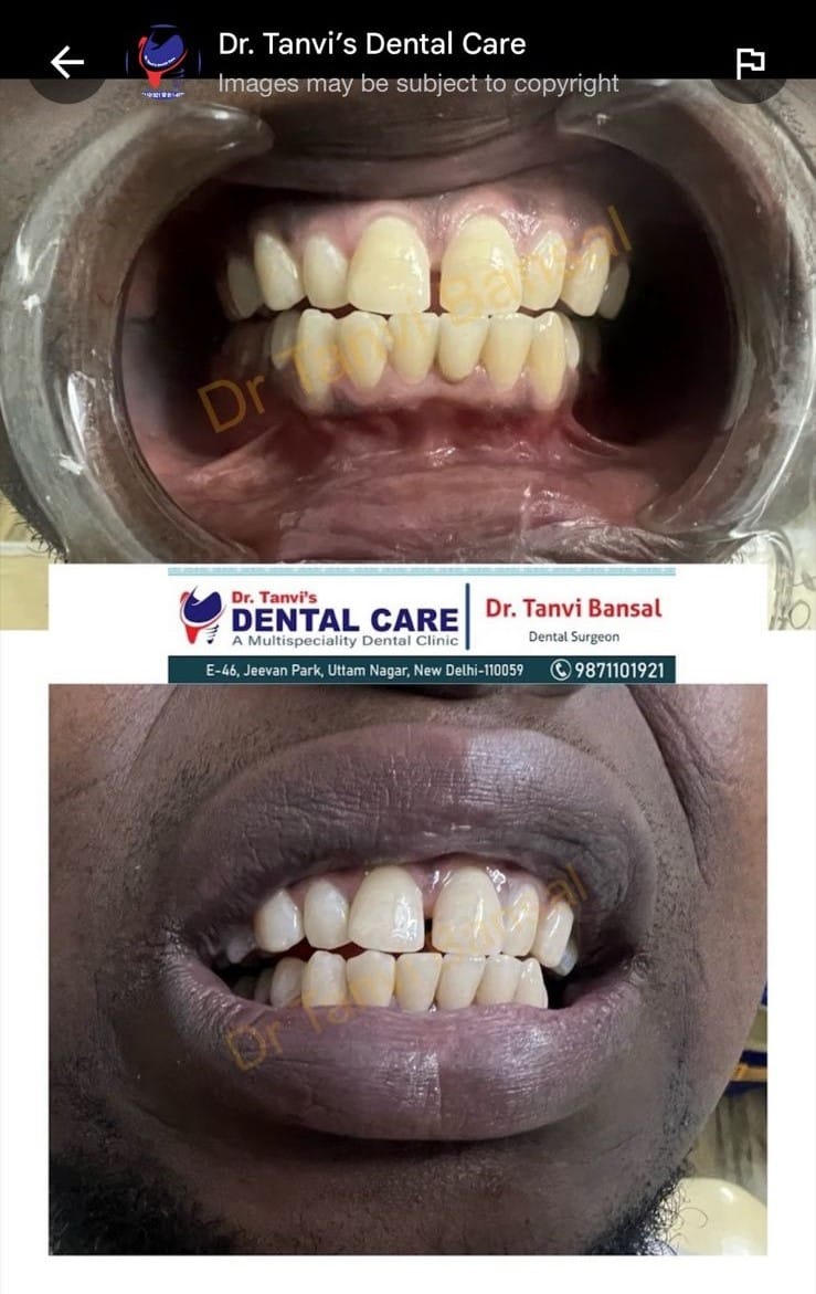 teeth whitening