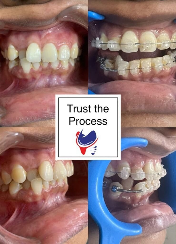 Orthodontic Treatment
