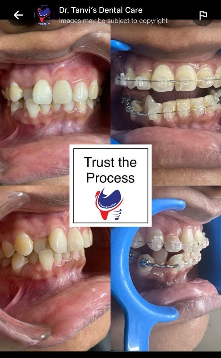 Orthodontic Treatment