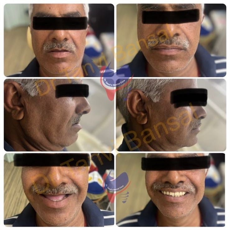 complete denture