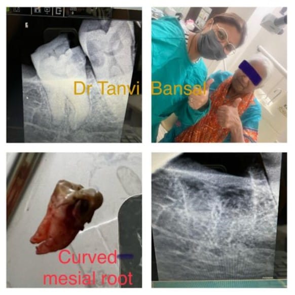 wisdom tooth removal